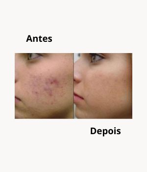 Comparação antes e depois de tratamento de rosto com Andreia Santos. Redução visível de borbulhas, vermelhidão e textura irregular da pele.