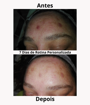 Resultados após 7 dias de rotina personalizada criada por Andreia Santos – melhoria visível na pele da testa com redução de borbulhas.