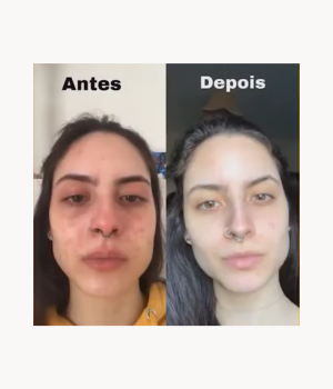 Antes e depois de cuidados personalizados — redução significativa de acne, vermelhidão e textura irregular na pele do rosto.