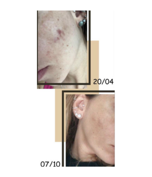 Evolução da pele entre abril e outubro com acompanhamento de Andreia Santos — redução de manchas e uniformização do tom da pele.