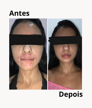 Antes e depois de tratamento personalizado para acne – melhoria visível na pele do rosto, com redução de borbulhas e vermelhidão.