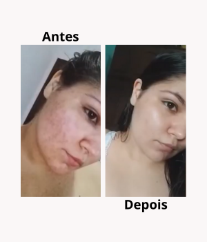 Antes e depois de cuidados de pele — redução de acne inflamada, melhoria da textura e aumento da luminosidade natural da pele.